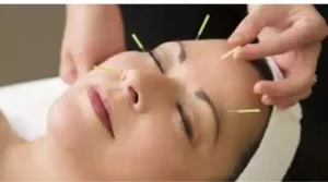 cursos acupuntura-auriculoterapia-estética-curso online-acupuntura estética-curso homologado