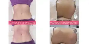 marcacion abdominal antes y despues-abdomen plano-masa muscular-lipo